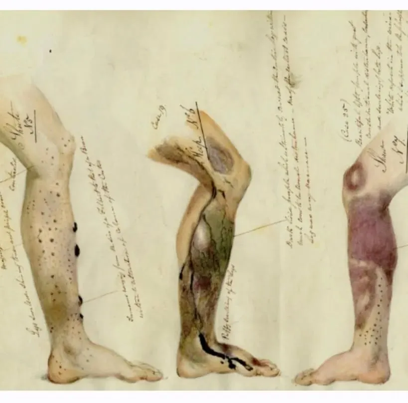 Ilustração médica antiga de pernas com as manchas e feridas do escorbuto